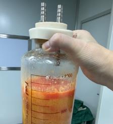郓城水动力吸脂手术要做多久？